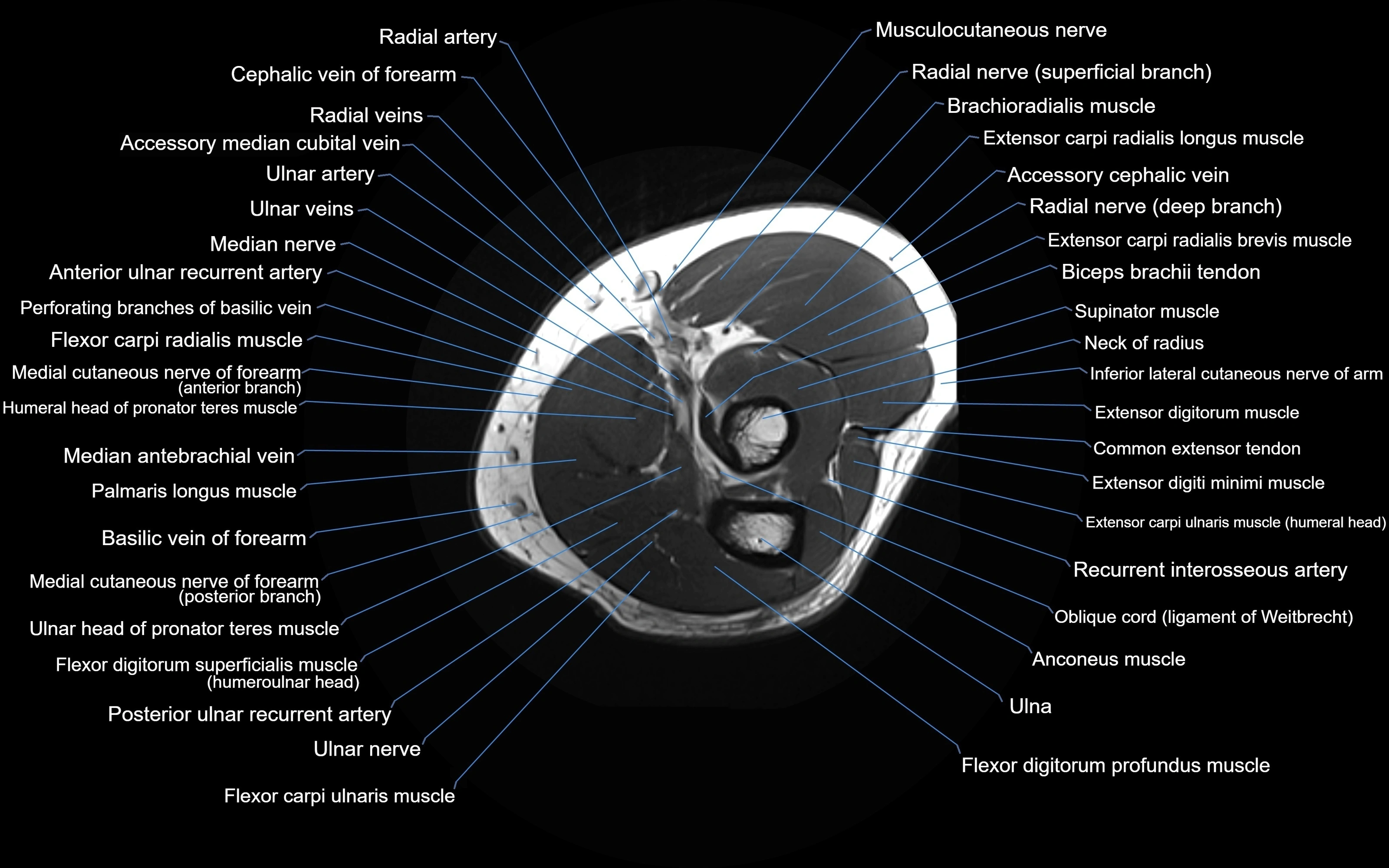 MRI elbow axial cross sectional anatomy 3T  radiology  image-img-00001-00023.webp